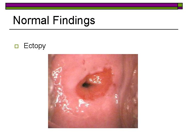 Normal Findings o Ectopy 