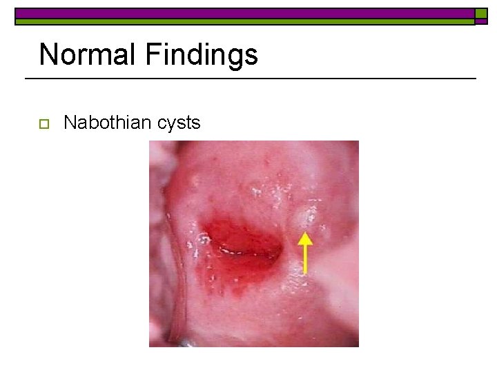 Normal Findings o Nabothian cysts 