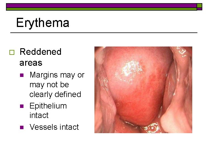 Erythema o Reddened areas n n n Margins may or may not be clearly