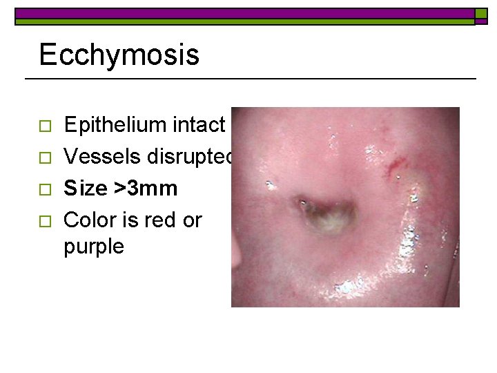 Ecchymosis o o Epithelium intact Vessels disrupted Size >3 mm Color is red or