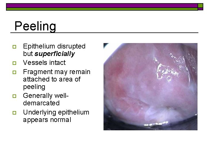 Peeling o o o Epithelium disrupted but superficially Vessels intact Fragment may remain attached