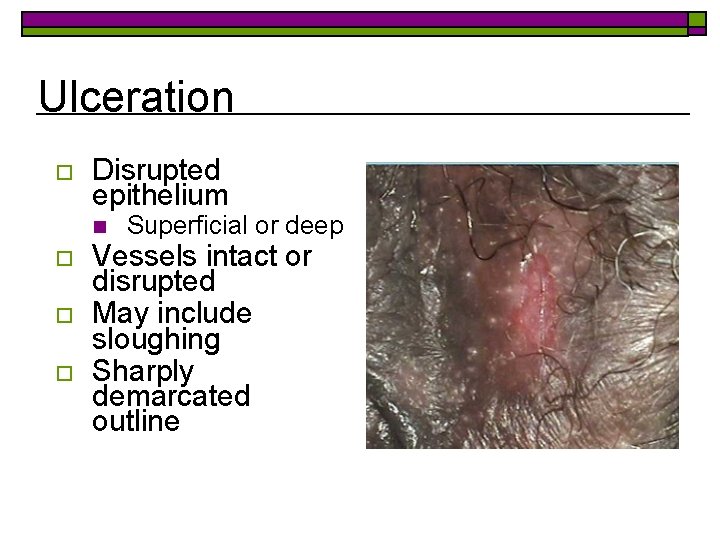 Ulceration o Disrupted epithelium n o o o Superficial or deep Vessels intact or