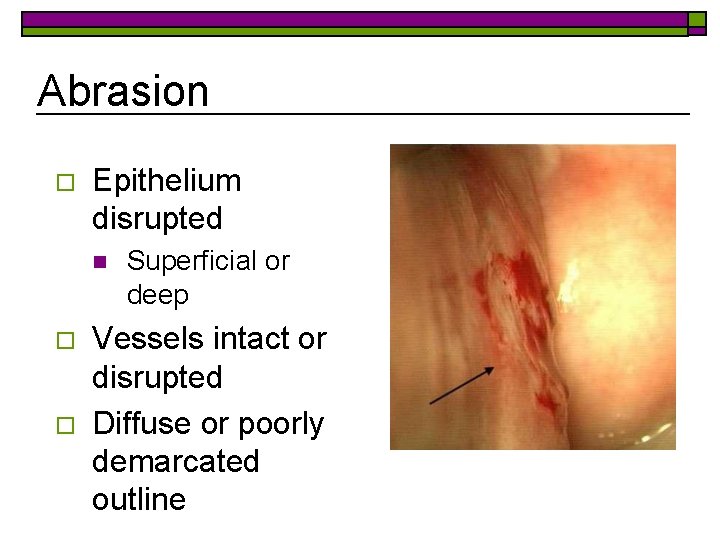 Abrasion o Epithelium disrupted n o o Superficial or deep Vessels intact or disrupted