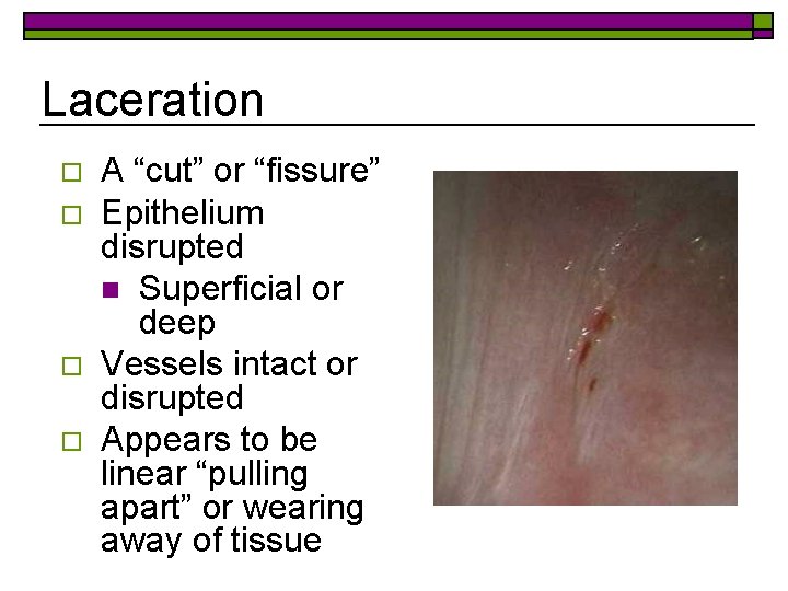 Laceration o o A “cut” or “fissure” Epithelium disrupted n Superficial or deep Vessels