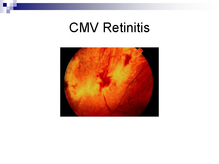 CMV Retinitis 