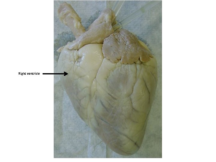 Right ventricle 