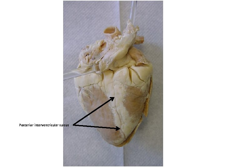 Posterior interventricular sulcus 