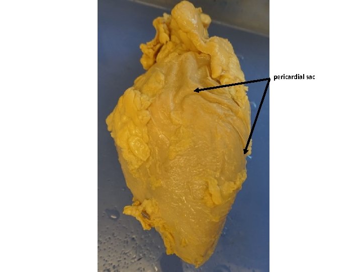 pericardial sac 