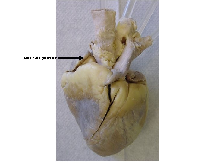 Auricle of right atrium 