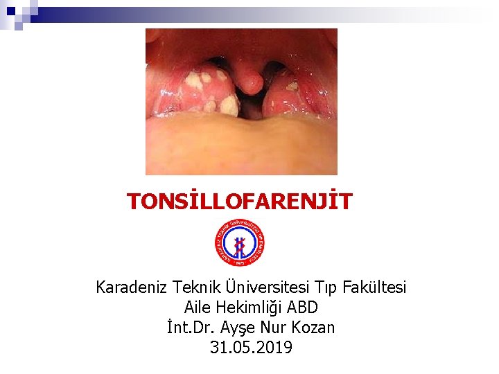 TONSİLLOFARENJİT Karadeniz Teknik Üniversitesi Tıp Fakültesi Aile Hekimliği ABD İnt. Dr. Ayşe Nur Kozan