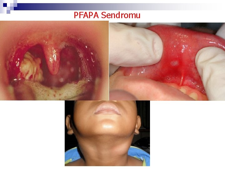 PFAPA Sendromu 