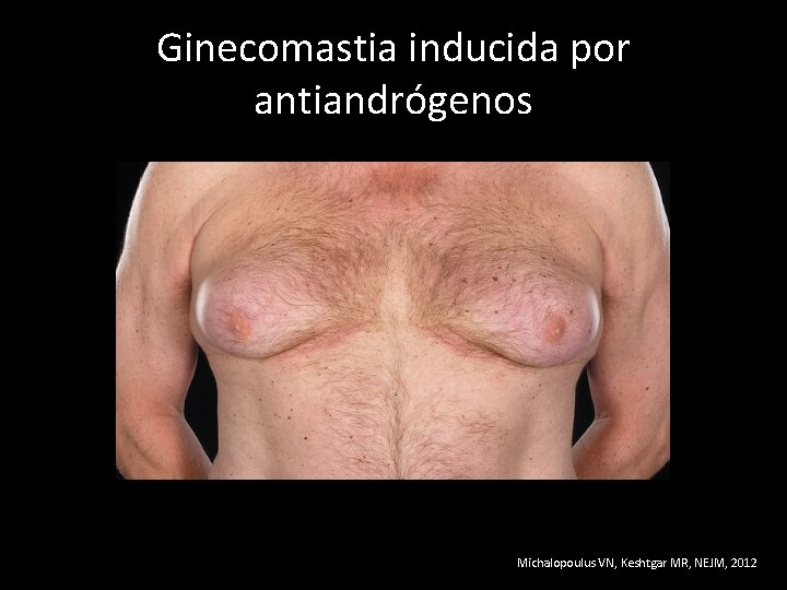 Ginecomastia inducida por antiandrógenos Michalopoulus VN, Keshtgar MR, NEJM, 2012 