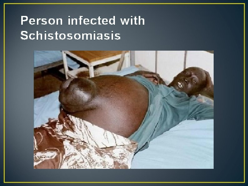 Person infected with Schistosomiasis 