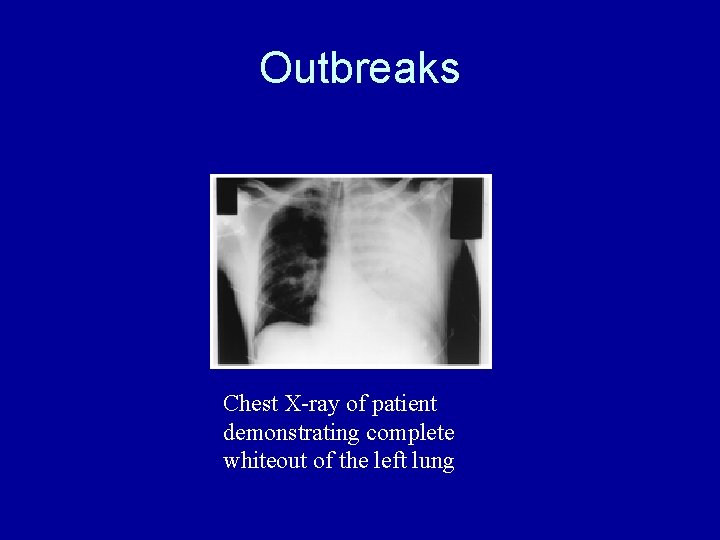 Outbreaks Chest X-ray of patient demonstrating complete whiteout of the left lung Outbreaks Chest X-ray of patient demonstrating complete whiteout of the left lung
