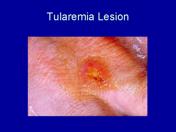 Tularemia Lesion Tularemia Lesion
