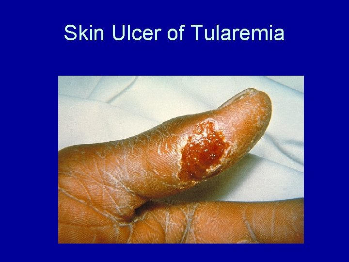 Skin Ulcer of Tularemia Skin Ulcer of Tularemia