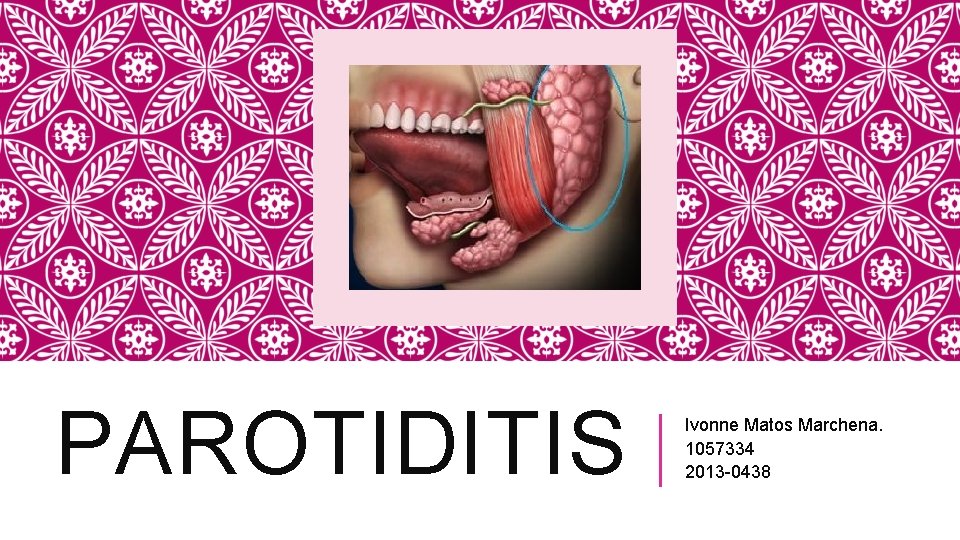 PAROTIDITIS Ivonne Matos Marchena. 1057334 2013 -0438 