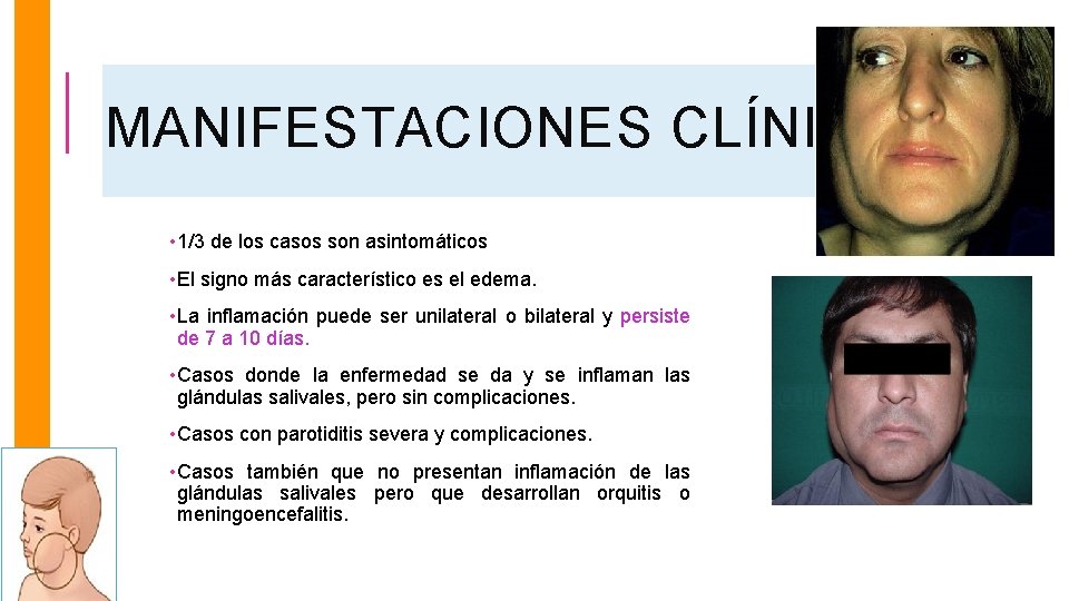 MANIFESTACIONES CLÍNICAS. • 1/3 de los casos son asintomáticos • El signo más característico