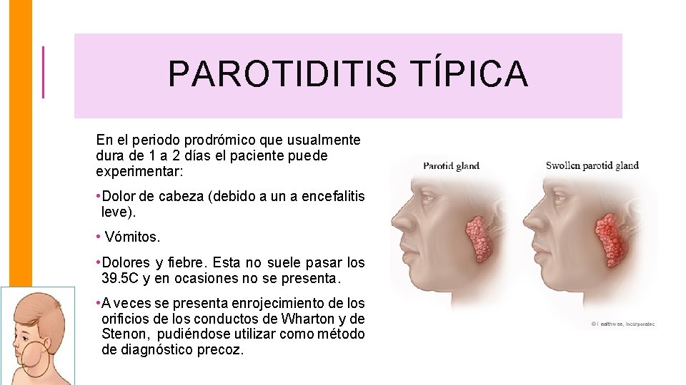 PAROTIDITIS TÍPICA En el periodo prodrómico que usualmente dura de 1 a 2 días