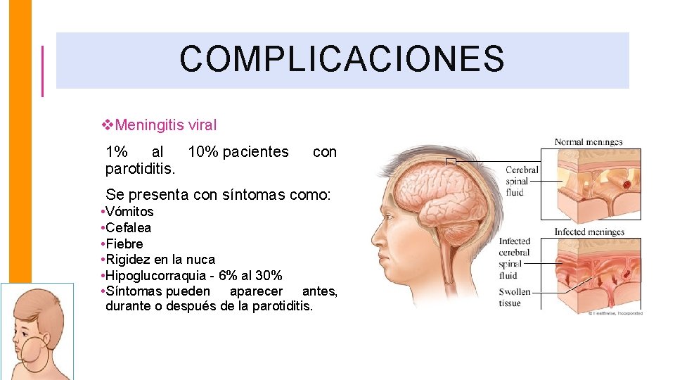 COMPLICACIONES v. Meningitis viral 1% al 10% pacientes parotiditis. con Se presenta con síntomas