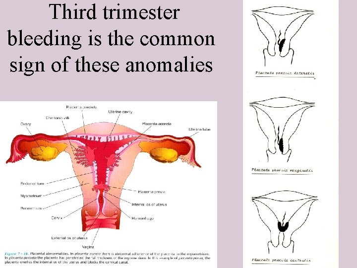 Third trimester bleeding is the common sign of these anomalies 15 