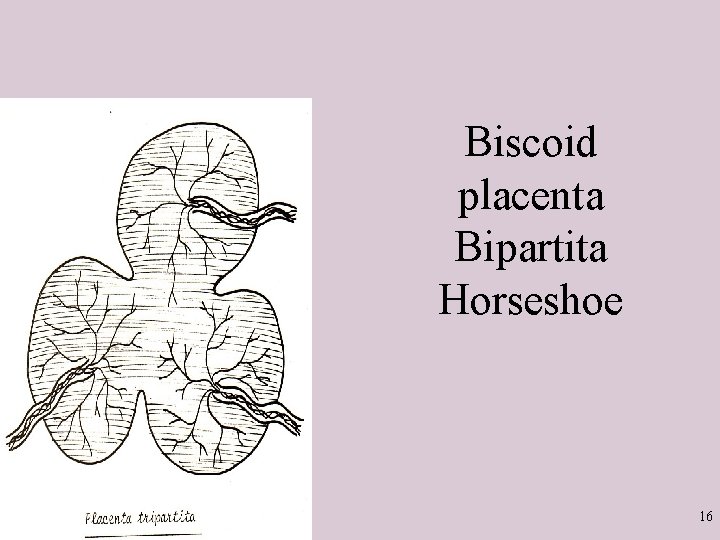 Biscoid placenta Bipartita Horseshoe 16 