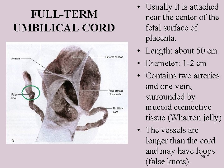FULL-TERM UMBILICAL CORD • Usually it is attached near the center of the fetal