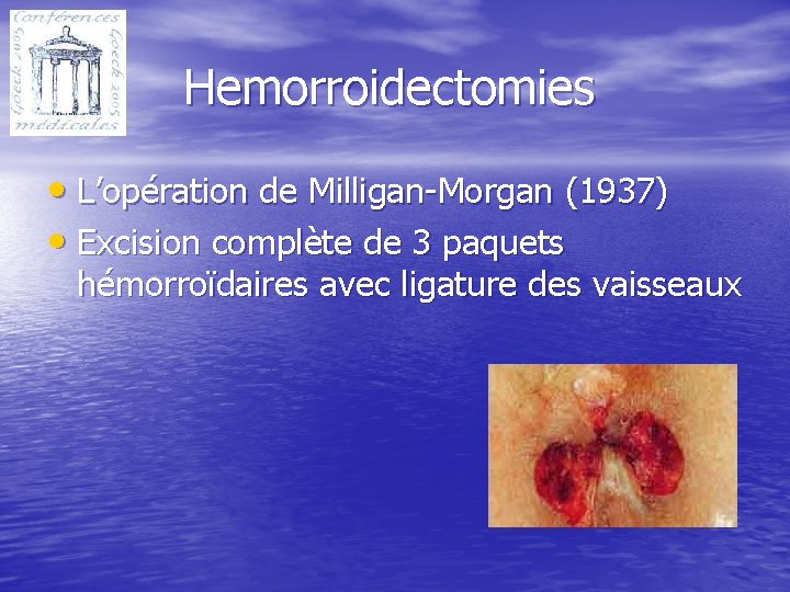 Hemorroidectomies • L’opération de Milligan-Morgan (1937) • Excision complète de 3 paquets hémorroïdaires avec