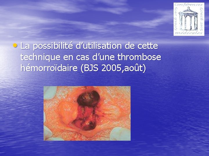  • La possibilité d’utilisation de cette technique en cas d’une thrombose hémorroïdaire (BJS