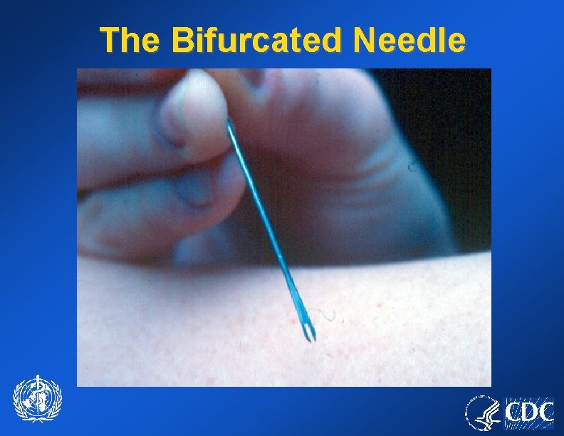 The Bifurcated Needle 