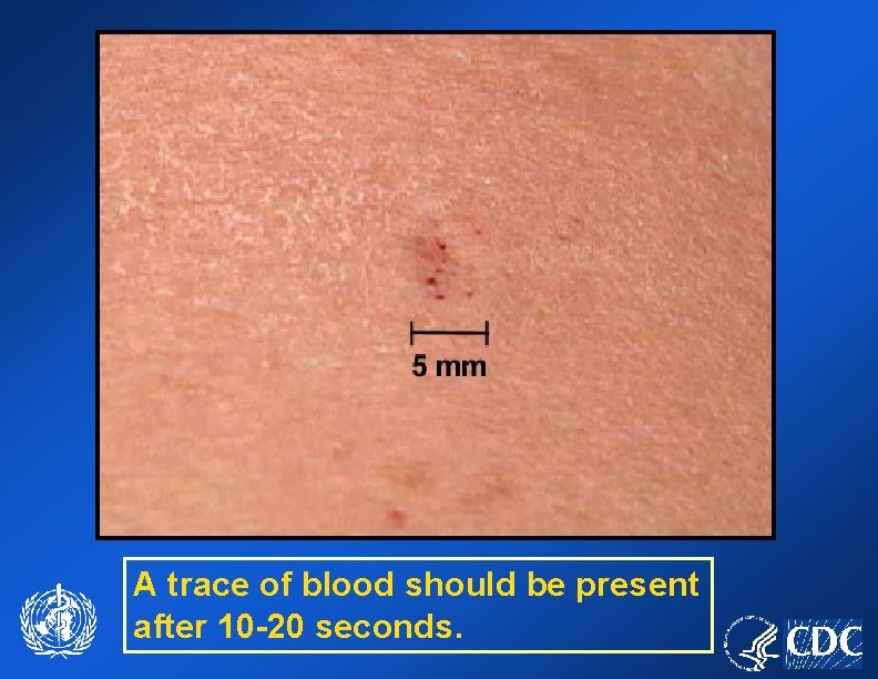 A trace of blood should be present after 10 -20 seconds. 