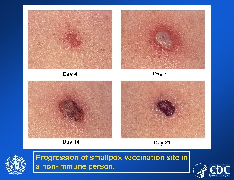 Progression of smallpox vaccination site in a non-immune person. 