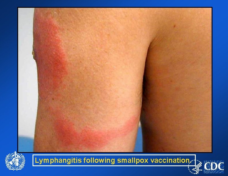 Lymphangitis following smallpox vaccination. 