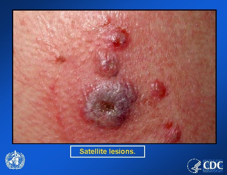 Satellite lesions. 