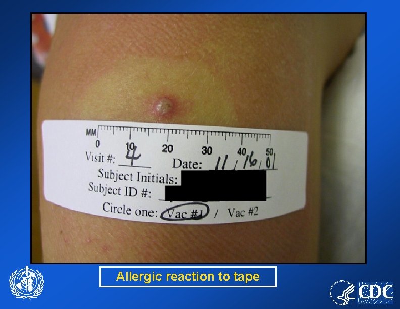 Allergic reaction to tape 