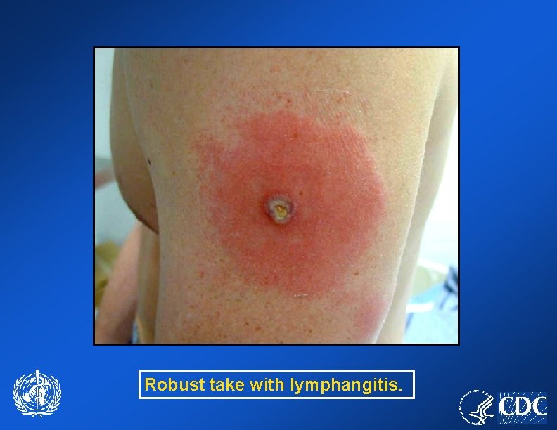 Robust take with lymphangitis. 