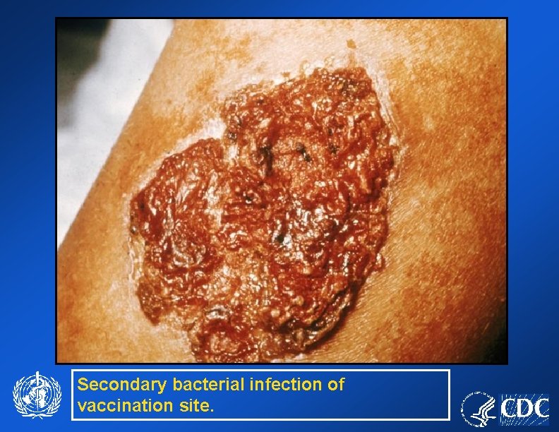 Secondary bacterial infection of vaccination site. 