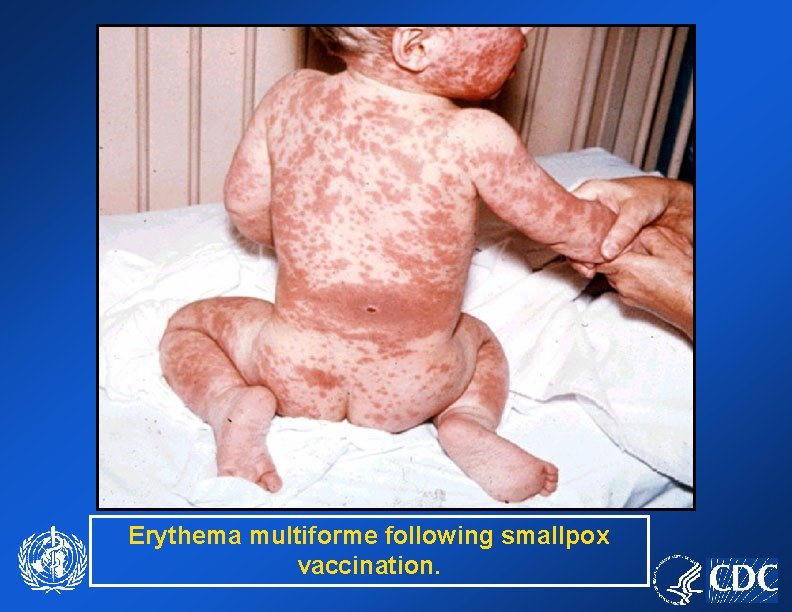 Erythema multiforme following smallpox vaccination. 