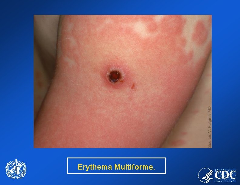 Erythema Multiforme. 
