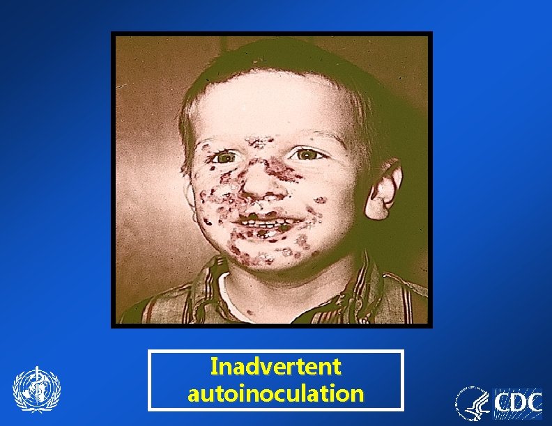 Inadvertent autoinoculation 
