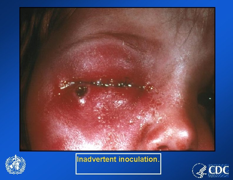 Inadvertent inoculation. 
