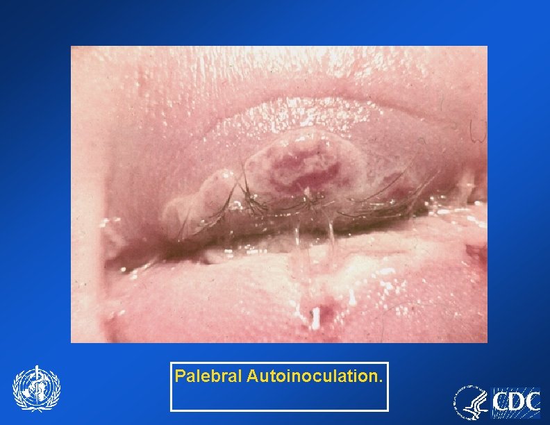 Palebral Autoinoculation. 