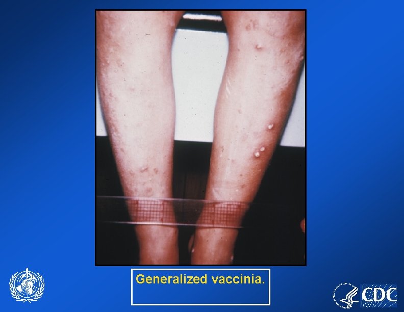 Generalized vaccinia. 