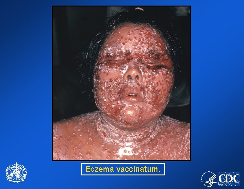 Eczema vaccinatum. 