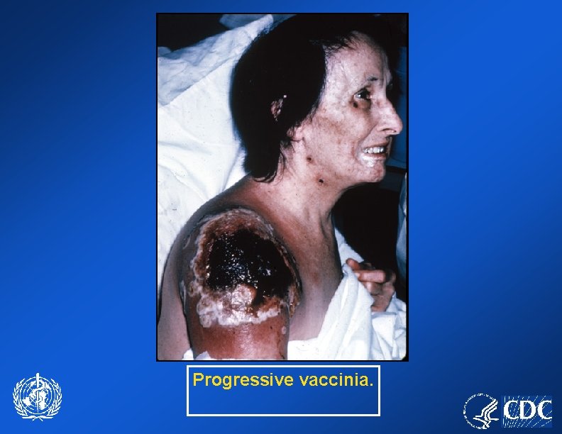 Progressive vaccinia. 