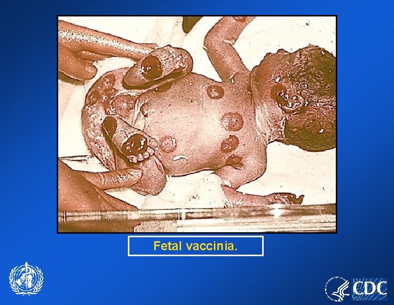 Fetal vaccinia. 