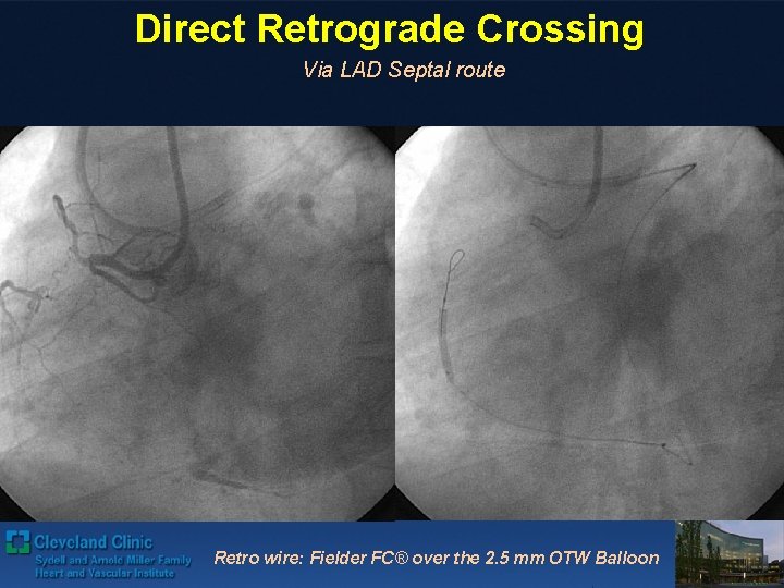 Direct Retrograde Crossing Via LAD Septal route Retro wire: Fielder FC® over the 2.