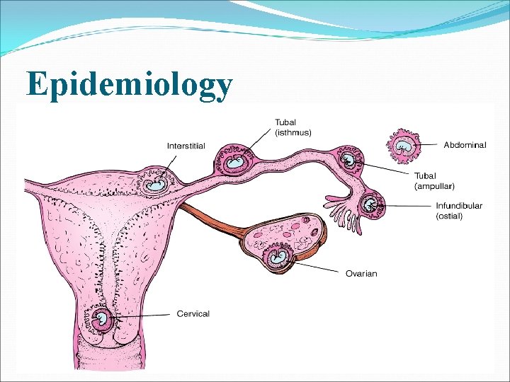Epidemiology Implantation of a fertilized ovum outside the endometrial cavity of the uterus. Occur Epidemiology Implantation of a fertilized ovum outside the endometrial cavity of the uterus. Occur