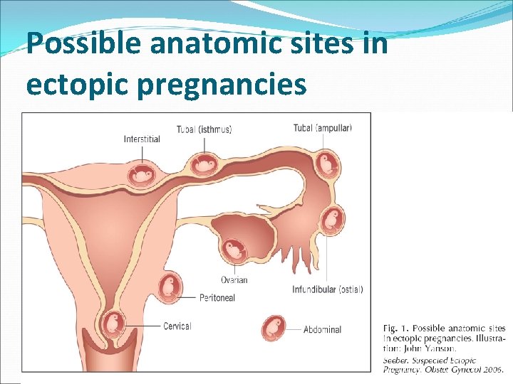 Possible anatomic sites in ectopic pregnancies Possible anatomic sites in ectopic pregnancies