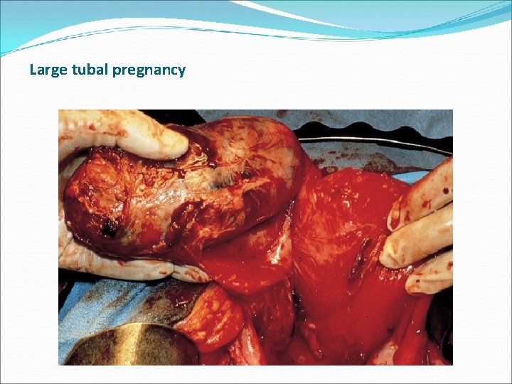 Large tubal pregnancy Large tubal pregnancy